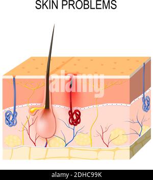 Hautprobleme. Verstopfte Poren. Sebum und abgestorbene Hautzellen in der verstopften Pore fördern das Wachstum bestimmter Bakterien (Propionibacterium acnes) Stock Vektor