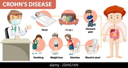 Medizinische Infografik zur Illustration der Morbus Crohn Stock Vektor