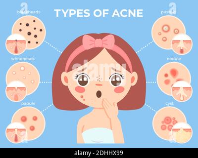 Mädchen mit Akne. Junge unglückliche weibliche Gesicht mit Hautproblemen und Pickel-Typen Symbole. Dermatologie und kosmetische Hautpflege Vektor-Infografik Stock Vektor