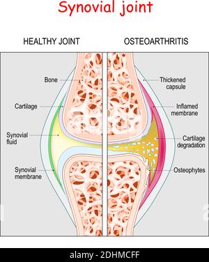 Arthrose. Gesunde Gelenkverbindung und Knie mit Arthritis oder Schmerzen. Degenerative Gelenkerkrankung Stock Vektor