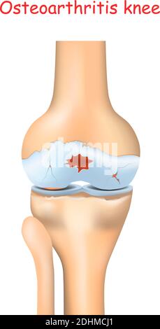 Kniearthritis. Arthritis oder Gelenkschmerzen. Degenerative Gelenkerkrankung. Realistische Vektordarstellung Stock Vektor