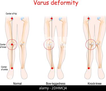 Valgus-Deformitäten. Gesundes Gelenk, Knock-Knie und Bow-Leggedness. Menschliche Beine, Knochen und Gelenke. Stock Vektor