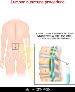 Lendenwirbelpunktion. Wirbelsäulenzapfen Verfahren. Detailliertes Diagramm der Lendenwirbelpunktion. Menschliche Silhouette mit Wirbelsäule. Spritzennadel Stock Vektor