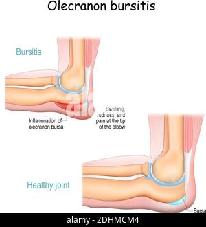 Olecranon Bursitis. Student Ellenbogen. Erkrankung. Entzündung des Bursa befindet sich unter dem Ellenbogen Olecranon. Trauma oder repetitive kleinere Trauma Stock Vektor