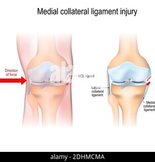 Mediale Knieverletzungen. Gelenkanatomie. Vektorgrafik für biologische, medizinische, wissenschaftliche und pädagogische Verwendung Stock Vektor