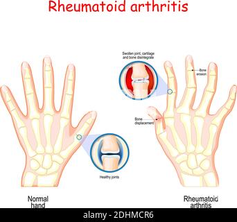 Rheumatoide Arthritis (RA). Gesunde Hand, und Hand mit rheumatoider Arthritis und typische Gelenkschwellung und Verformung der Finger und Knöchel Stock Vektor