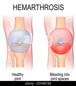 Hämarthrose (Hämarthrose) ist eine Blutung in Gelenkräume. Menschliche Anatomie. Zwei Kniegelenke: Gesund und verletzt Stock Vektor