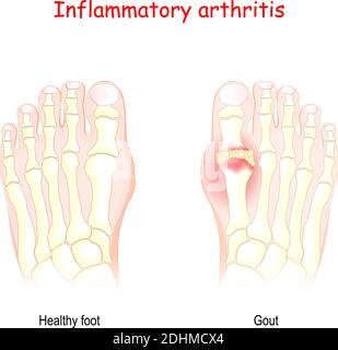 Gicht. Entzündliche Arthritis. Vektor-Diagramm von gesunden Fuß und Fuß mit Gicht. Harnsäure kristallisiert und die Kristalle in den Gelenken ablagern Stock Vektor