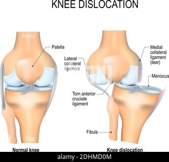 Knieverfall und normal. Seitliche Traumata zum Knie, zerrissene Seitenbänder, Kreuzbandverletzung und Meniskusverletzung. Menschliche Anatomie Stock Vektor
