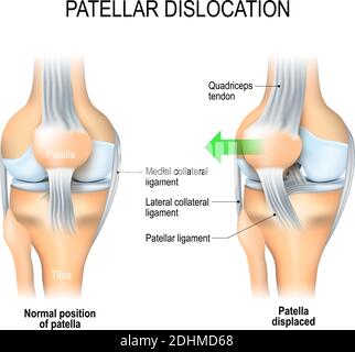 Patellardislokation. Normale Position von Kniescheibe und Patella verschoben. Anatomie des Knies Stock Vektor