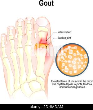 Gicht ist eine Form der entzündlichen Arthritis. Gekennzeichnet durch erhöhte Harnsäurespiegel im Blut. Diese Harnsäure kristallisiert Stock Vektor