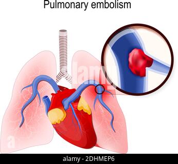Lungenembolie. Blockierung der Hauptarterie der Lunge oder eines ihrer Zweige durch ein Blutgerinnsel, das von anderswo im Körper gereist ist Stock Vektor