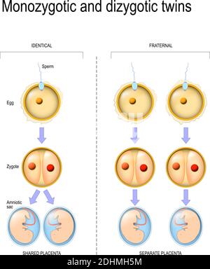 Unterschied und Vergleich der Zygote-Entwicklung bei monozygotischen und dizygotischen Zwillingen. Stock Vektor