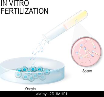 In-vitro-Fertilisation. Künstliche Befruchtung. Petrischale mit menschlichen Eiern. Reagenzglas mit Sperma. Stock Vektor