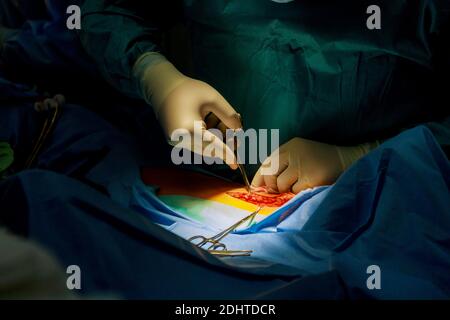 Patienten mit einem schneiden unsere Schnitt ein wenig tiefer menschlichen Beines mit blutigen Narbe von der Operation. Stockfoto