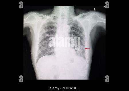 Ein Röntgenfilm des Thorax eines Patienten mit der linken unteren Seite Lungenpneumonie und rechte obere Lungenknochen Stockfoto