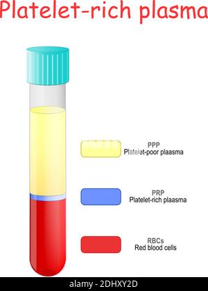 Thrombozytenreiches Plasma. Blutschichten in Glasröhrchen. Reagenzglas mit PRP. In vitro. Stock Vektor