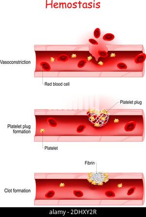 Hämostase. Grundlegende Schritte der Wundheilungsprozess (Platelet Plug Bildung und Vasokonstriktion). Blutgefäßverletzung und Entzündung. vektor-Diagramm Stock Vektor