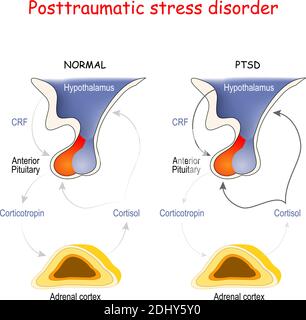 Posttraumatische Belastungsstörung. Nebennierenrinde, Hypophyse und Hypothalamus. Regionen des Gehirns, die mit Stress und PTSD assoziiert sind. Stock Vektor