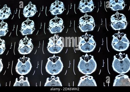 Computertomographie Bild Scan des Gehirns. CT-Film eines menschlichen Schädels und Gehirns mit intrakranialem Shunt. Neurologischer Hintergrund. Medizin, Wissenschaft. Stockfoto