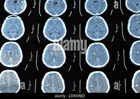 Computertomographie Bild Scan des Gehirns. CT-Film eines menschlichen Schädels und Gehirns mit intrakranialem Shunt. Neurologischer Hintergrund. Medizin, Wissenschaft. Stockfoto