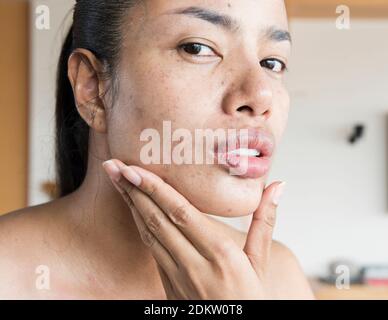 Closeup Fur Akne Auf Frauen Kinn Stockfotografie Alamy