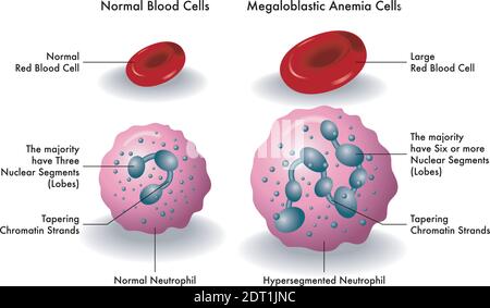 Medizinische Illustration zeigt den Unterschied zwischen normalen Blutzellen und megaloblastischen Anämie-Zellen. Stock Vektor