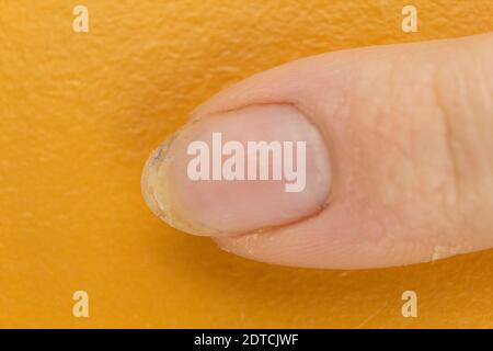 Onychomykose einer Nagelkrankheit, bei der die Nägel sich abpeeln Stockfoto