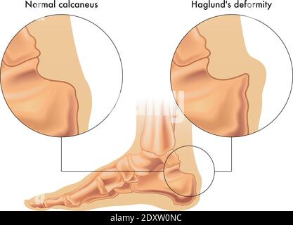 Medizinische Illustration zeigt den Vergleich zwischen einem normalen Calcaneus und einem von Haglunds Deformität betroffenen, mit Anmerkungen. Stock Vektor