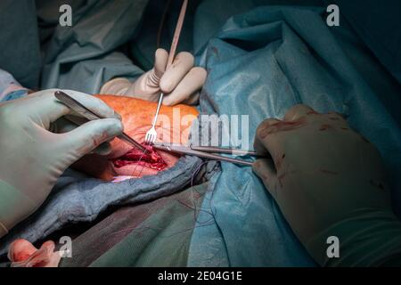 Bei einer Operation wird eine Ellenbogenfraktur von Ärzten behandelt Mit einer Titanplatte Stockfoto