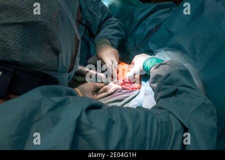 Bei einer Operation wird eine Ellenbogenfraktur von Ärzten behandelt Mit einer Titanplatte Stockfoto