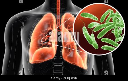 3D-Abbildung zeigt Legionellen pneumophila Bakterien in der menschlichen Lunge Stockfoto