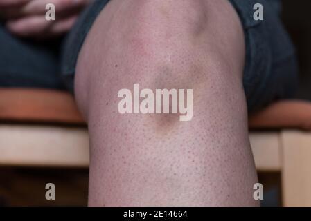 Blauer Fleck auf dem Knie - Nahaufnahme Wundhämatom, Prellung Stockfoto