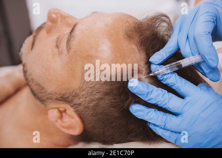Nahaufnahme eines reifen Mannes, der Haarausfall-Behandlung-Injektionen in die Kopfhaut von einem professionellen Trichologen erhält. Dermatologe macht Kopfhaut Injektionen für Matur Stockfoto
