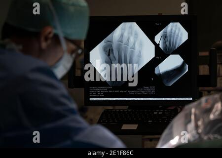 Ansicht eines Bildschirms mit der Röntgenaufnahme eines Fußes Im Operationssaal Stockfoto