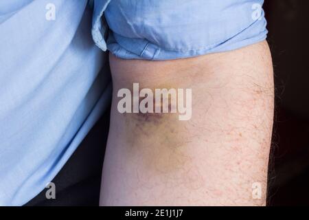 Leichte bis mäßige Blutergüsse am Oberarm eines Mannes in den Tagen nach der Entnahme einer Blutprobe. Stockfoto