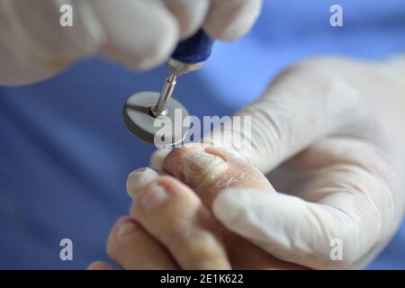 chiropody Drehmaschine, die Onychomykose poliert, infiziert Zehennägel Stockfoto