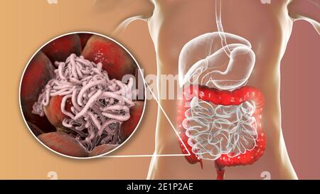 Runde Würmer im menschlichen Dickdarm, Illustration Stockfoto