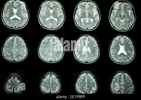 MRT-Untersuchung des Gehirns eines Patienten Stockfoto