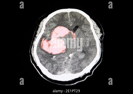 Ein CT-Scan eines Schlaganfallpatienten, der intrazerebrale Blutungen in den CD-Gerinnseln am rechten Thalamus, am Basalganglikon und am lateralen Ventrikel mit Gehirn zeigt Stockfoto