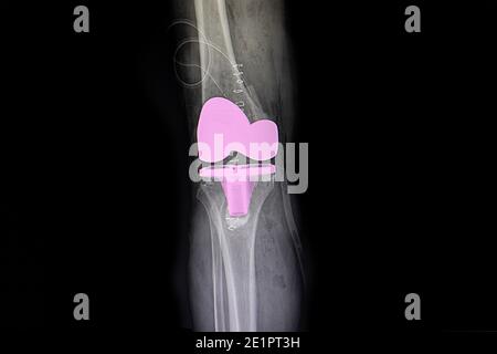 Röntgenfilm eines Patienten rechtes Knie nach totaler Knieartroplastik Operation. Stockfoto
