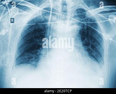 Röntgenkontrolle nach Herzoperation des Patienten. Stockfoto