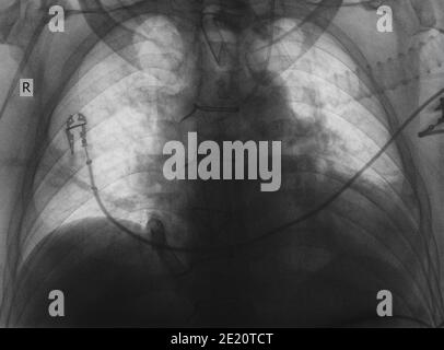 Röntgenuntersuchung des Patienten nach Herzoperation. Stockfoto