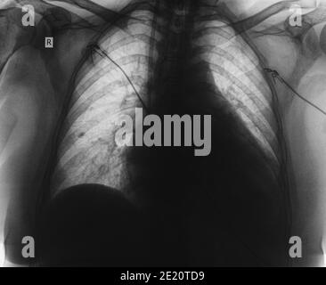 Roentgen-Bild des Patienten auf der Intensivstation. Stockfoto