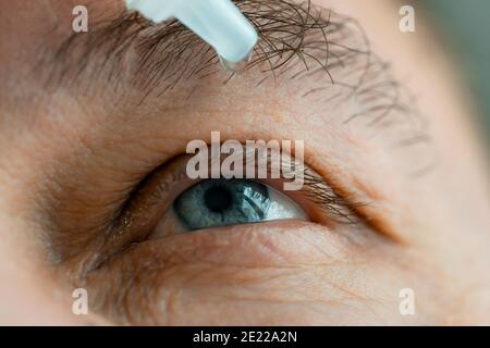 Ein Mann legt Augentropfen in seine Augen, bevor er Kontaktlinsen aufsetzt. Probleme mit der Lösungsvision. Stockfoto