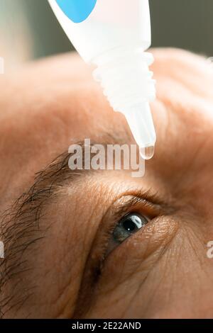 Ein Mann legt Augentropfen in seine Augen, bevor er Kontaktlinsen aufsetzt. Probleme mit der Lösungsvision. Stockfoto