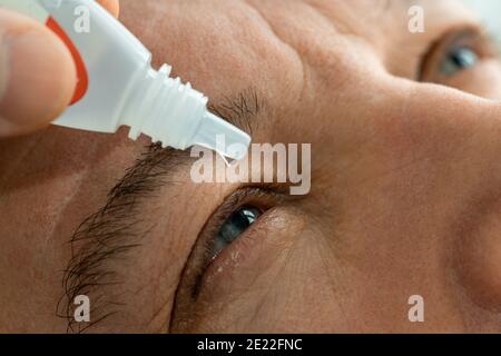 Ein Mann legt Augentropfen in seine Augen, bevor er Kontaktlinsen aufsetzt. Probleme mit der Lösungsvision. Stockfoto