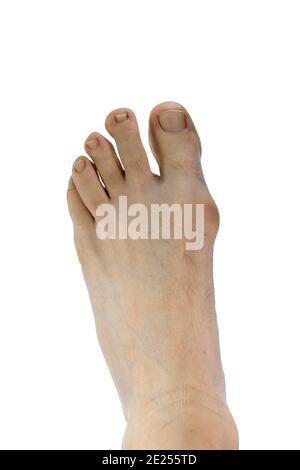 Toe Corrector Silikon Valgus Big Bunion Schiene Haarglätter Fuß. Silikon-Unterstützung für orthopädische. Hallux valgus, Bunion im Fuß auf weißem Hintergrund Stockfoto