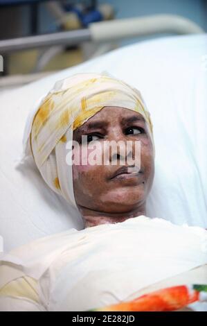 Der Äthiopier Shweyea Mullah, das ehemalige Kindermädchen im Haus Hannibal Gaddafis und von seiner Frau Aline verbrannt wurde, wird am 1. September 2011 in der Intensivstation des verbrannten Krankenhauses in Tripolis, Libyen, gesehen. Foto von Ammar Abd Rabbo/ABACAPRESS.COM Stockfoto