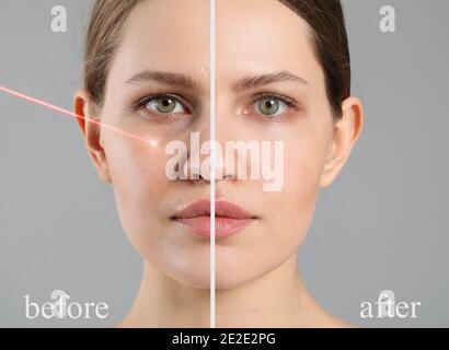 Gesicht der jungen Frau vor und nach der Behandlung mit Laser Auf grauem Hintergrund Stockfoto